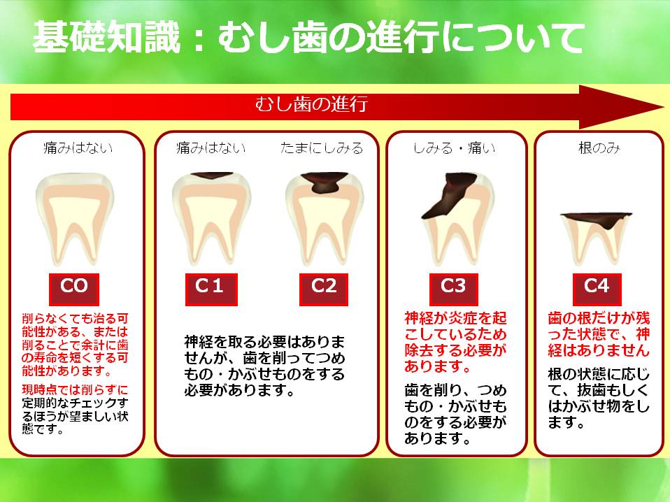 宮崎歯科医院 虫歯の進行と処置