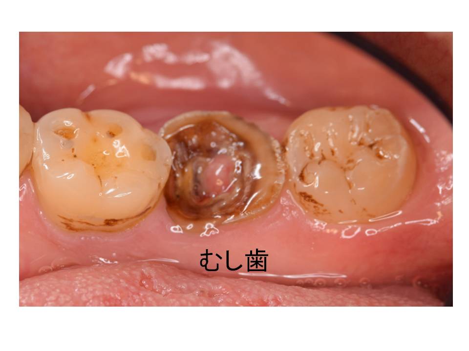 虫歯 自分 で 埋める