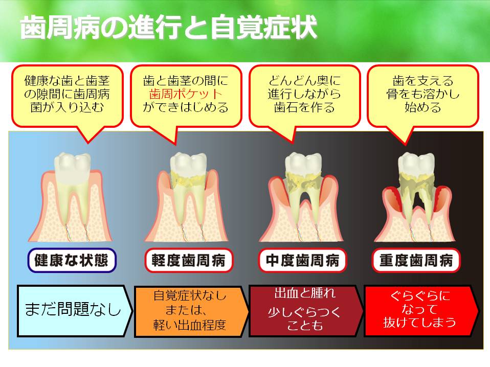 宮崎歯科医院 怖い歯周病 副鼻腔炎